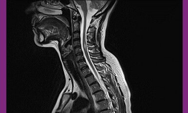 La sclérose en plaques : comment en parler à son entourage ?