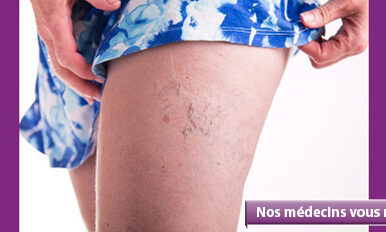Tout savoir sur l’opération des varices